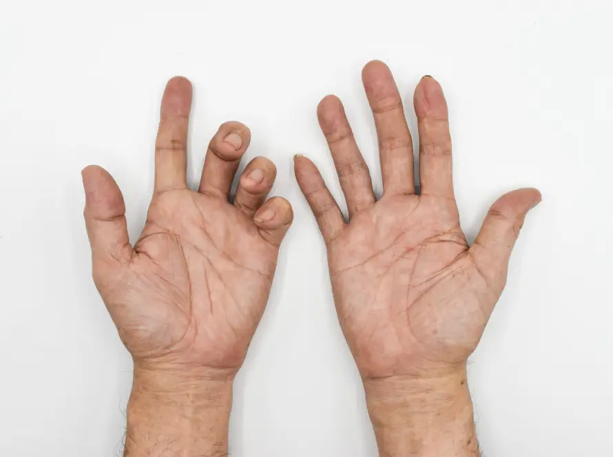 Ulnar Neuropathy