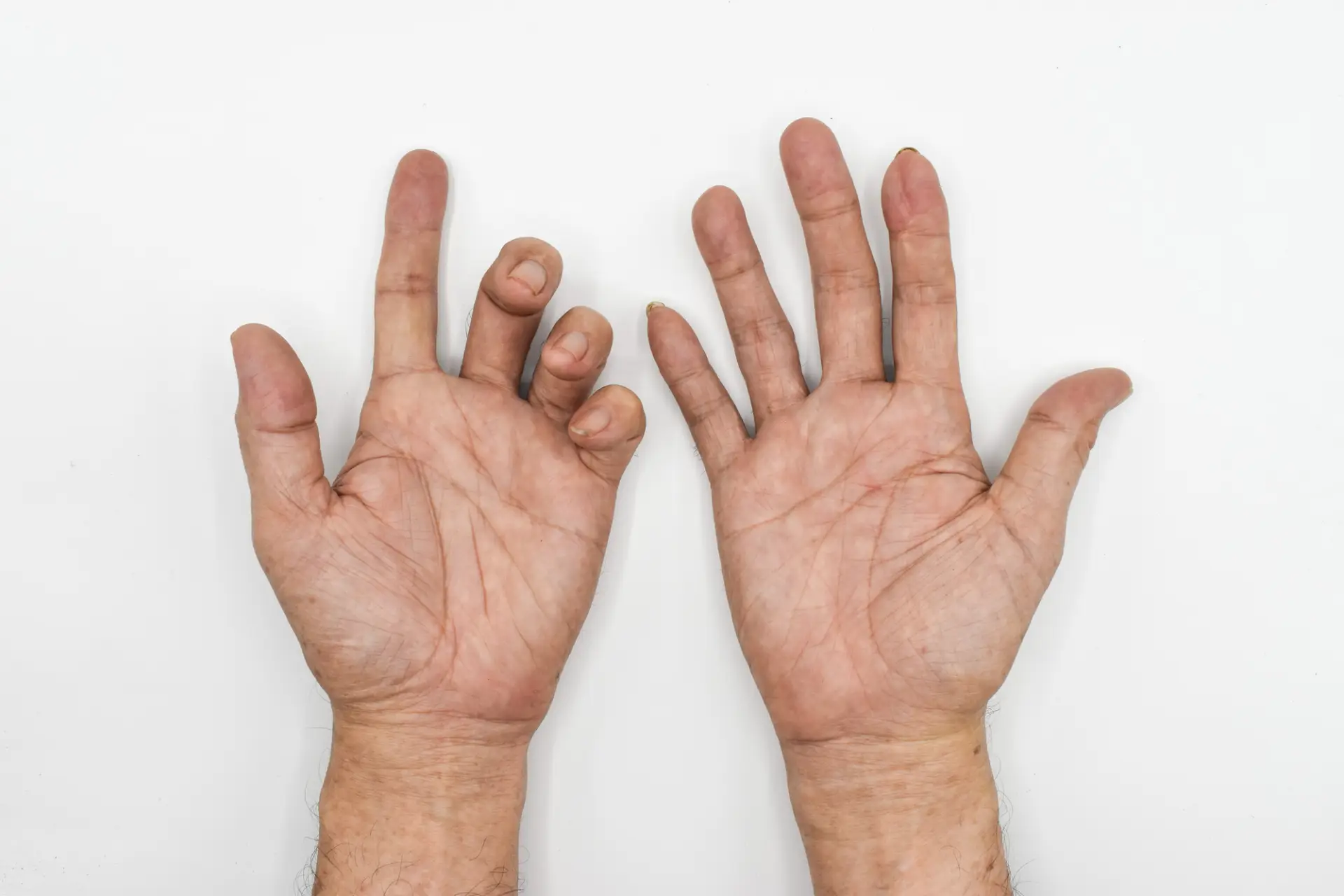 Ulnar Neuropathy