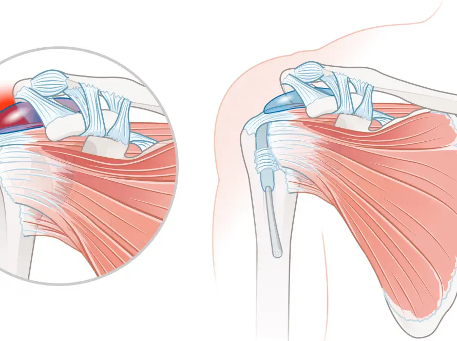 deltoid bursitis treatment