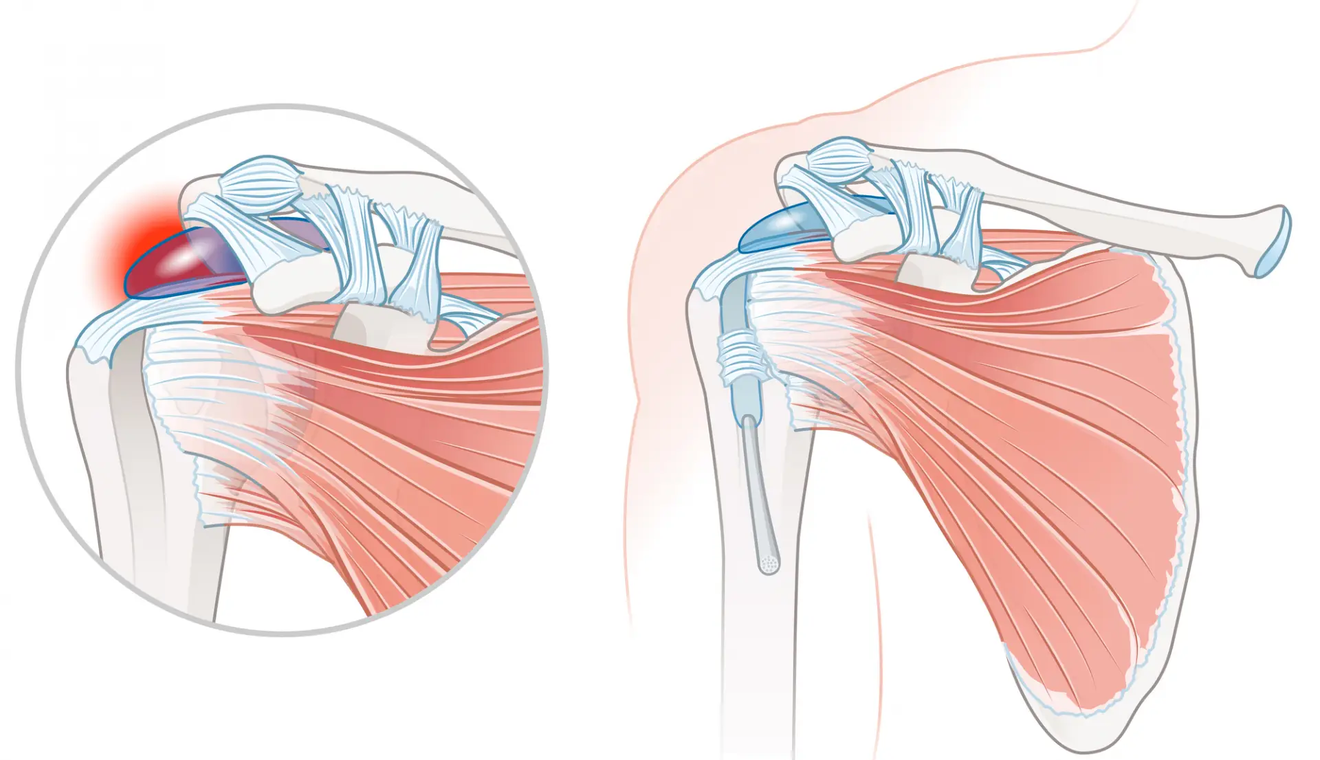 Deltoid Bursitis