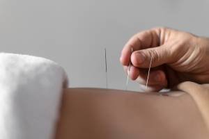 Therapeutic Dry Needling