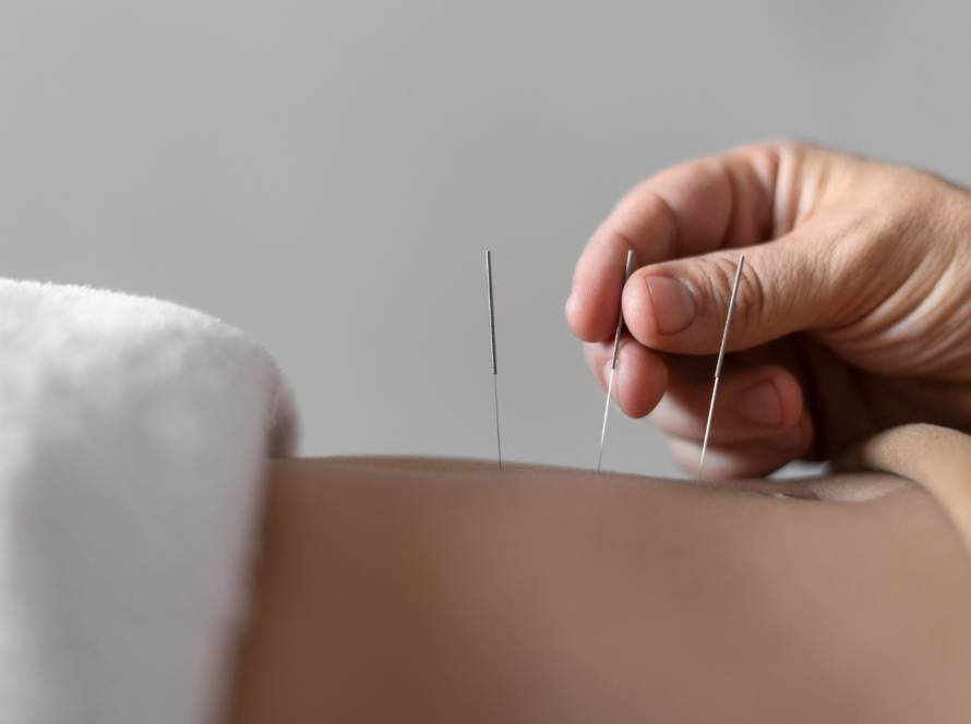 Therapeutic Dry Needling