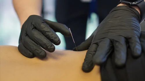 Expert Dry Needling Therapy Service in Houston TX